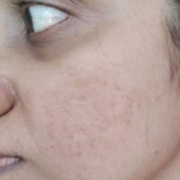 After using Bio Retinol Elixir